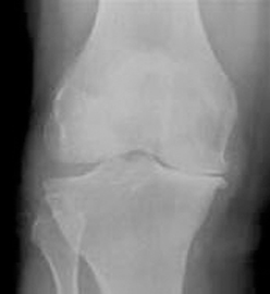Figure 4. Osteoarthritis of knee