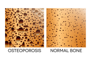 Osteoporosis, human bone anatomy. Medical illustration healthy bone and unhealthy bone.