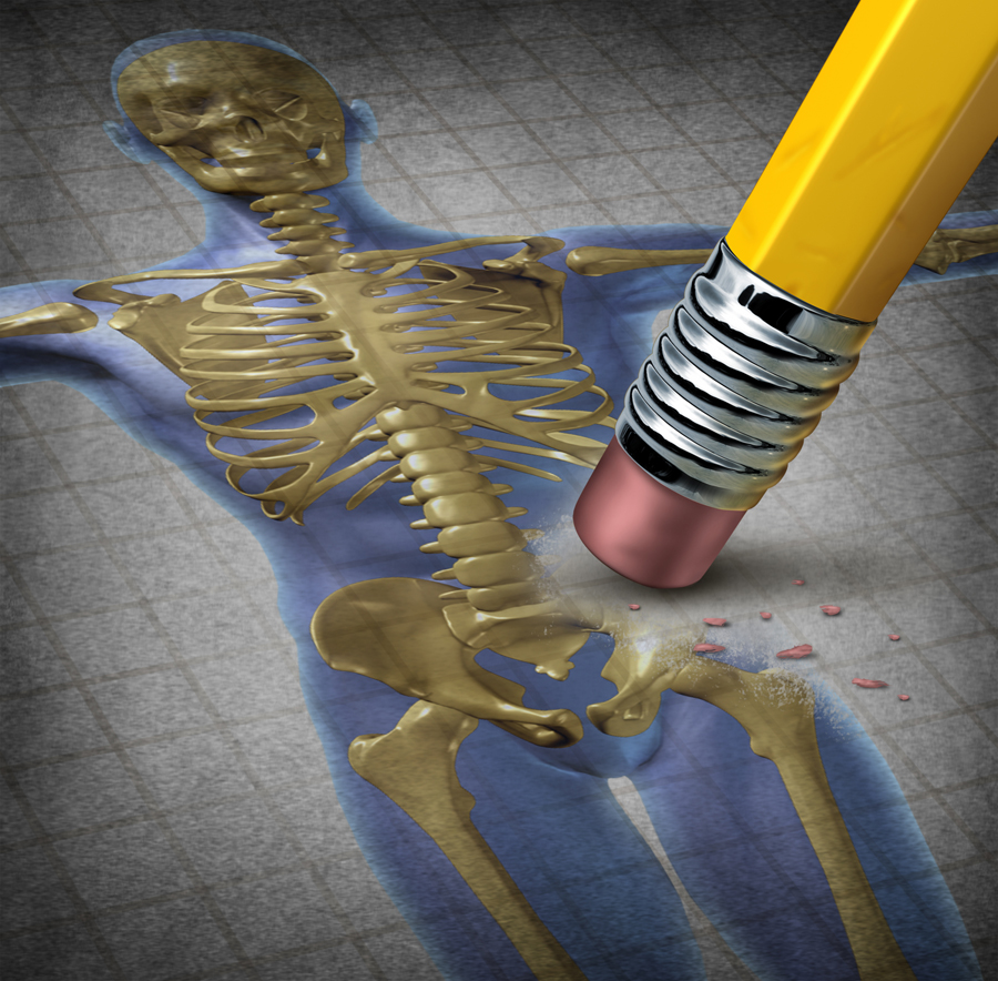 Human Osteoporosis