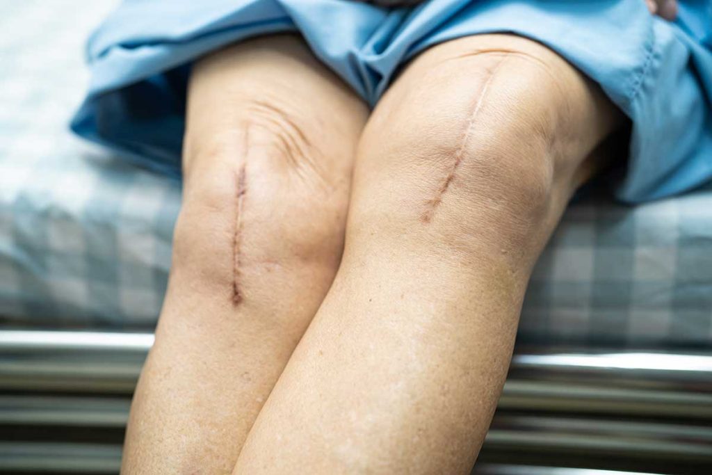 Surgical Scar Tissue Release