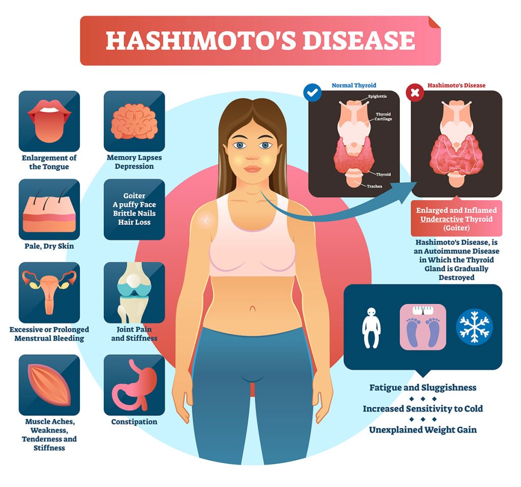 hashimoto-s-disease-when-the-immune-system-turns-against-you