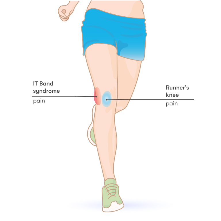 IT_band_syndrome_vs_Runner's_knee.svg